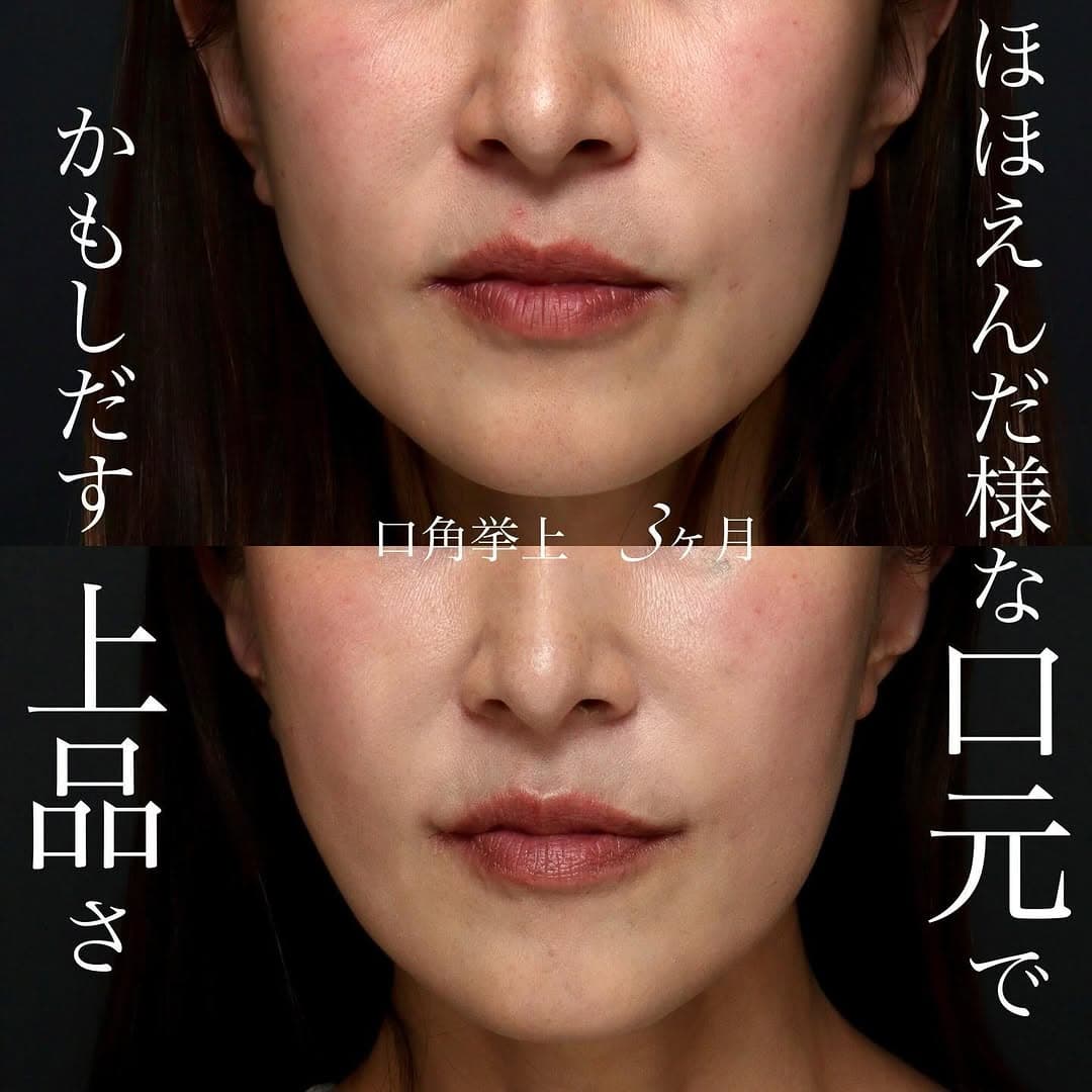 40代の口角挙上でほほえんだ口元の上品な印象を整えた症例