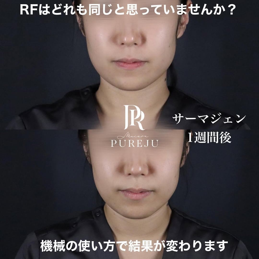 サーマジェン(RF)でフェイスラインを引き締めたるみを改善した症例