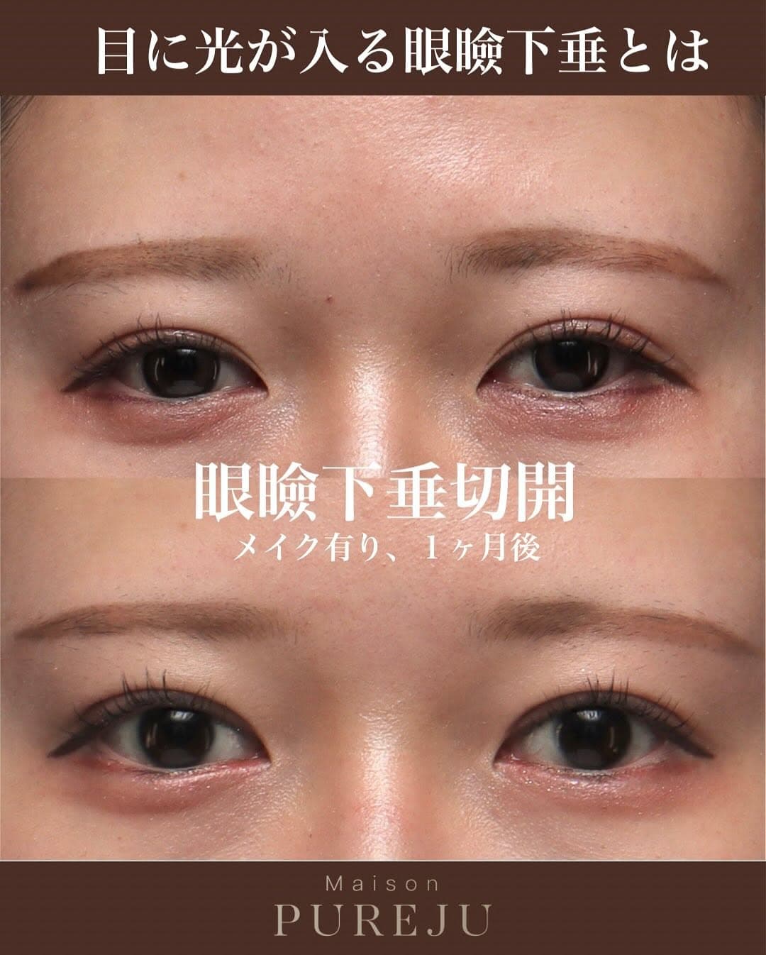 眼瞼下垂手術で隠れた黒目を見せ目の開きと印象を大きく改善した症例