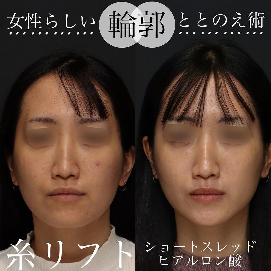 糸リフト+ショートスレッド+ヒアルロン酸でフェイスラインをすっきり整えた症例