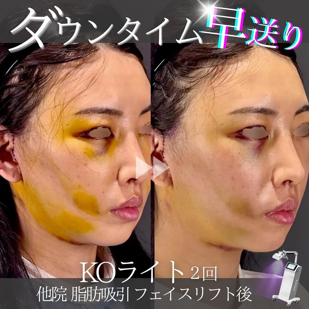 KOライト2日連続照射で他院フェイスリフト後の内出血と腫れを大幅に改善した症例