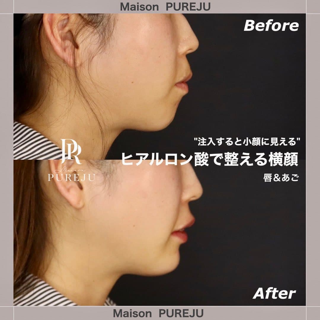 ヒアルロン酸注入で整える横顔|あご+唇で小顔効果とEライン改善