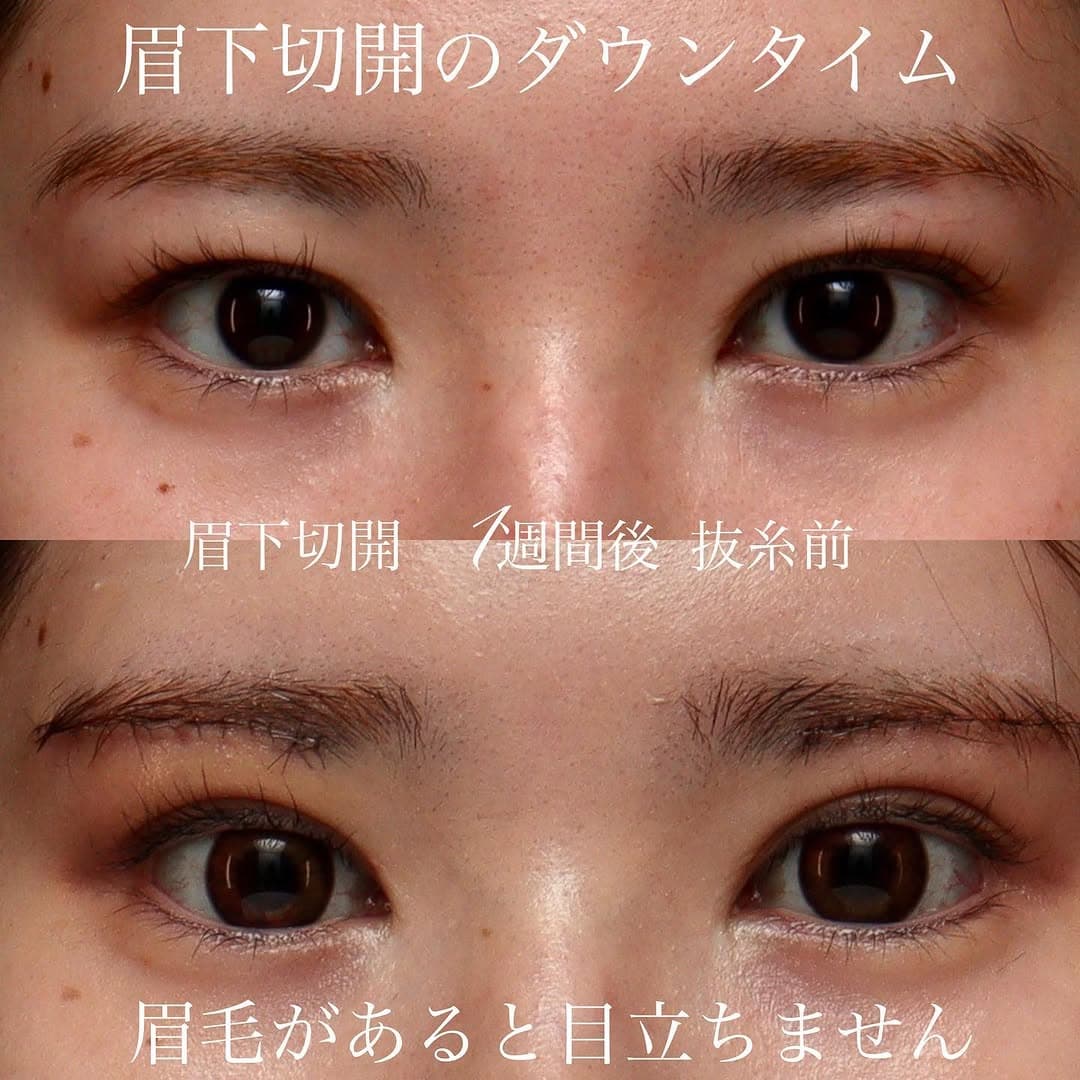 眉下切開術後1週間(抜糸前)のダウンタイムの経過