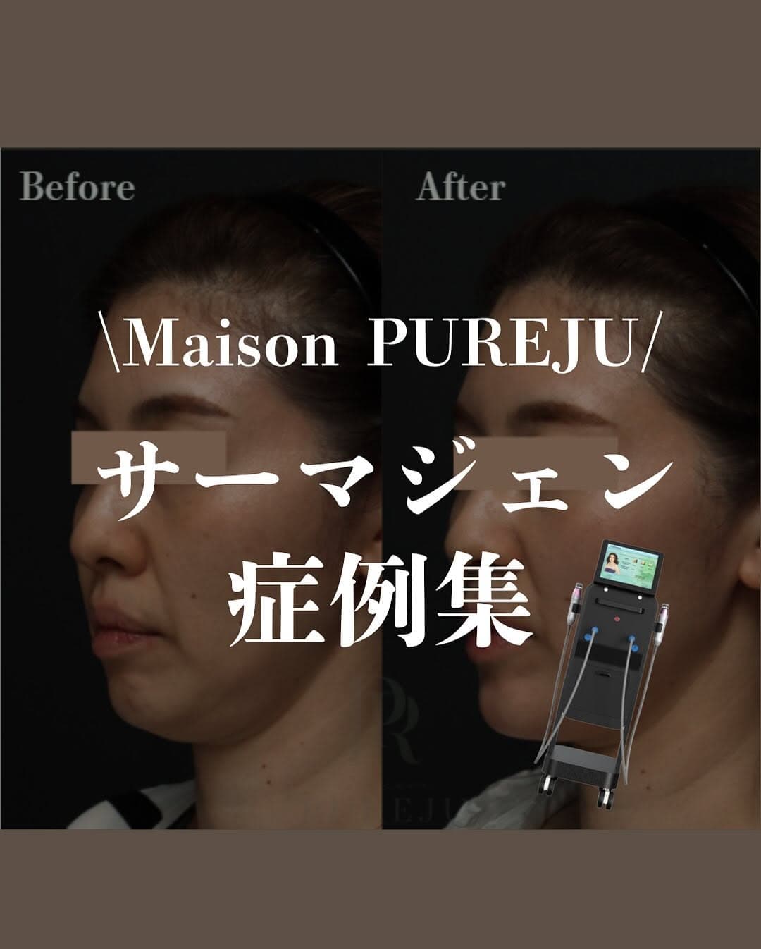 サーマジェン症例|高周波たるみ治療の2段階効果と当院こだわりのオーダーメイド照射