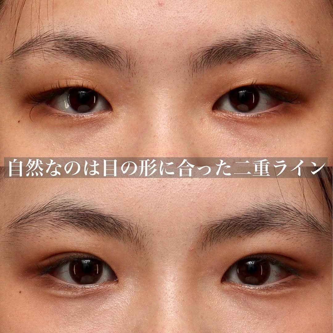骨格に合わせた自然な末広二重埋没で周りにバレない変化を実現した症例