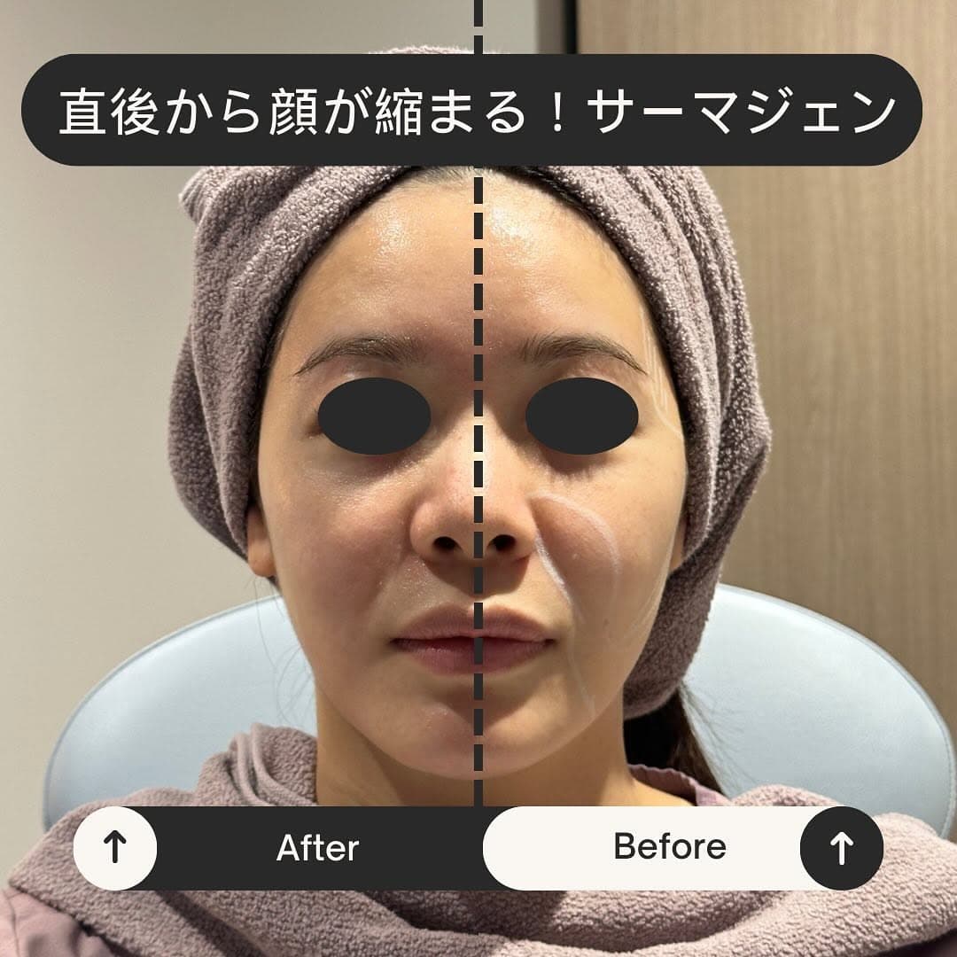愛してやまないサーマジェン!痛くない・ダウンタイムなし・効果高いの三拍子