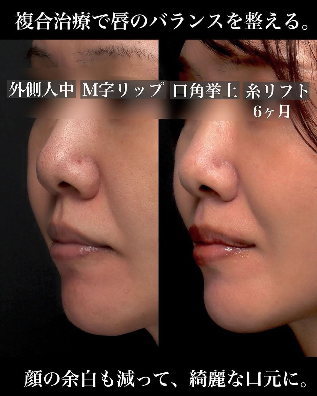 口角挙上+外側人中+人中短縮の複合治療で唇と口元全体のバランスを整えた症例
