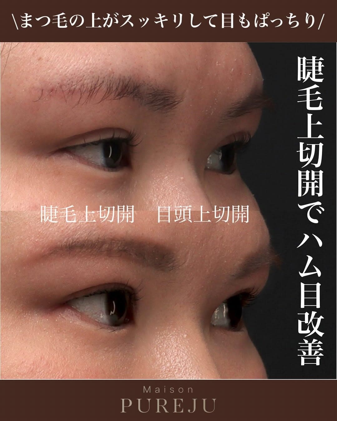 睫毛上切開でまつ毛と二重ラインの間のもたつきを改善しすっきりした目元にした症例