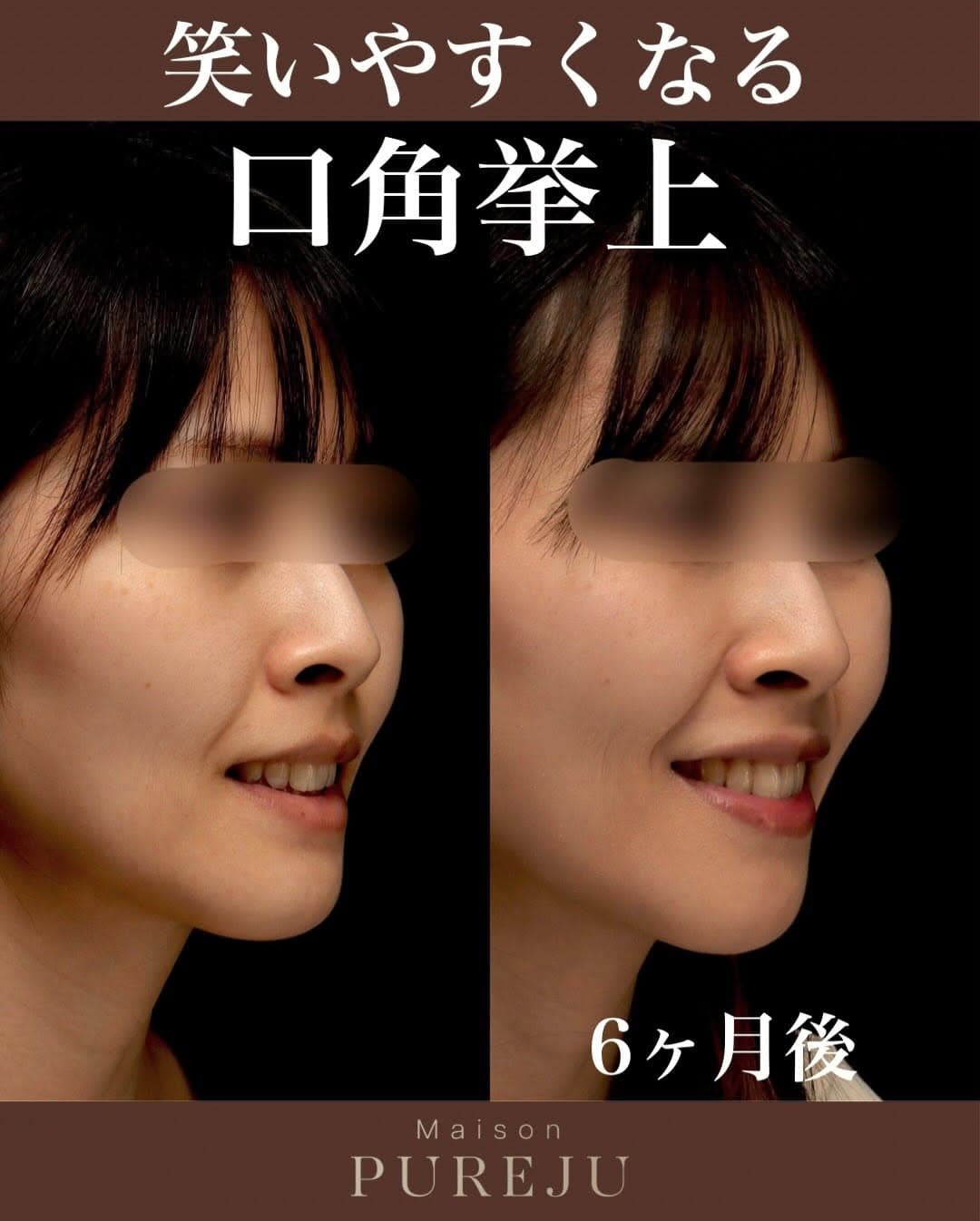 口角挙上で笑顔のぎこちなさを改善し自信を持って笑えるようになった症例
