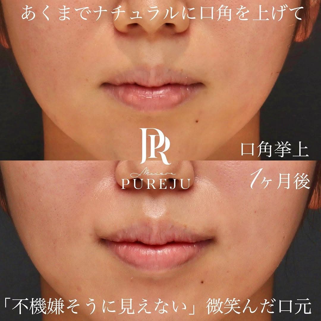 口角挙上でナチュラルに口角を上げ「不機嫌そう」な印象を改善した症例(術後1ヶ月)