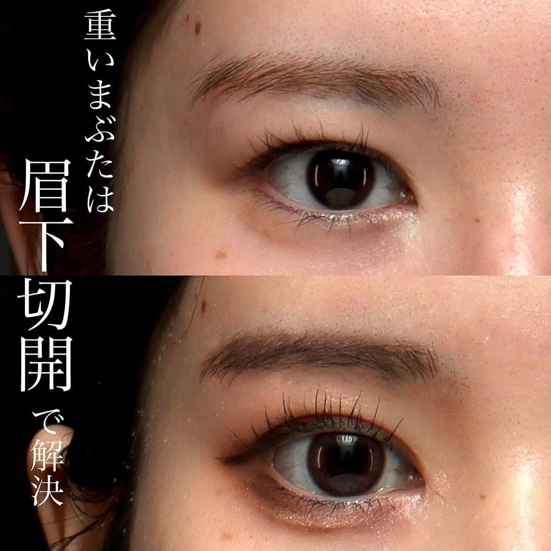 眉下切開でまぶたのもたつきをすっきり改善した症例(術後6ヶ月)
