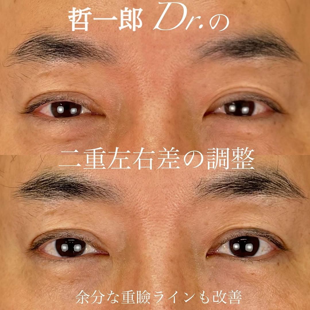二重全切開で二重ラインの左右差と余分なラインを改善した症例(術後2ヶ月)