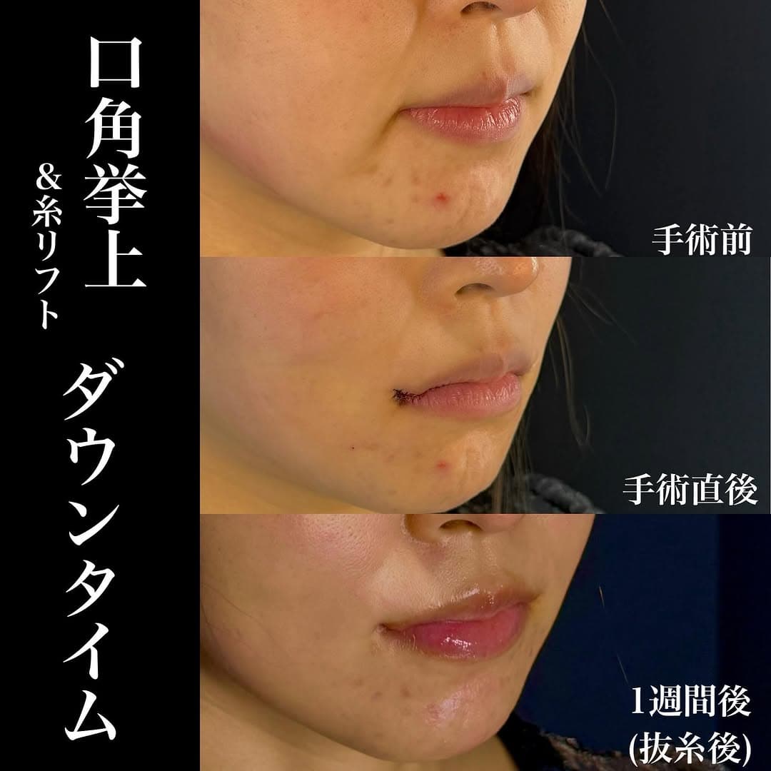 口角挙上+糸リフト術後1週間のダウンタイム経過を示した症例
