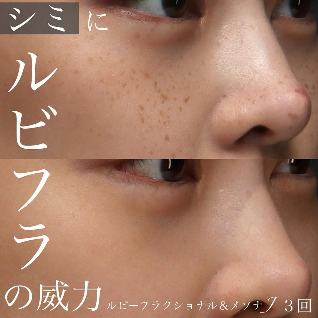 ルビーフラクショナルレーザーで細かいシミとそばかすを改善した症例