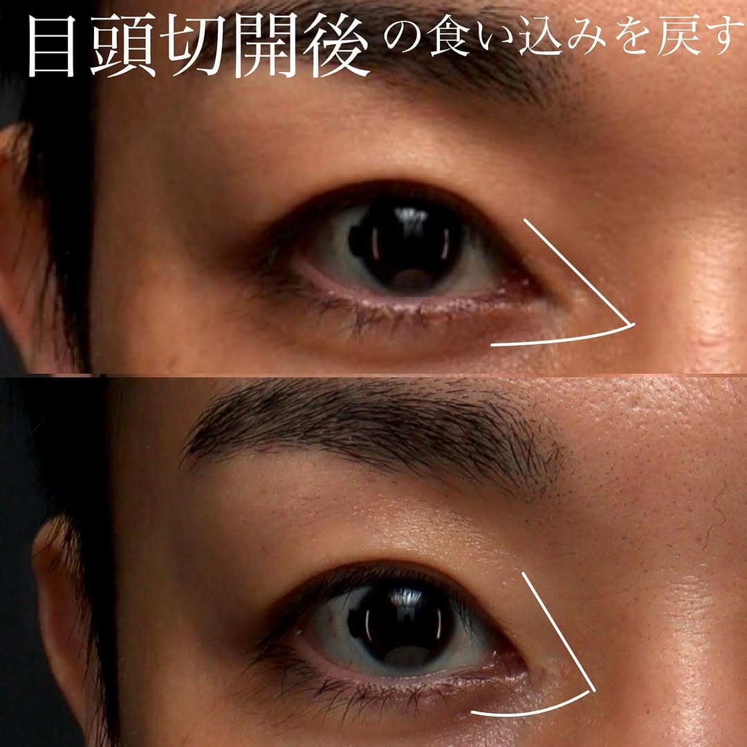 他院目頭切開後の蒙古ひだ形成修正で目頭が入り込みすぎた印象を自然に改善した症例