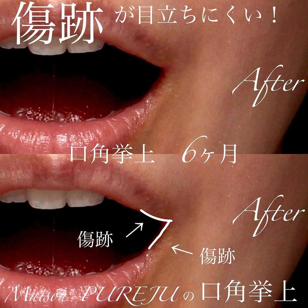 口角挙上の傷跡が目立ちにくい理由と口角形成の変化を示した症例