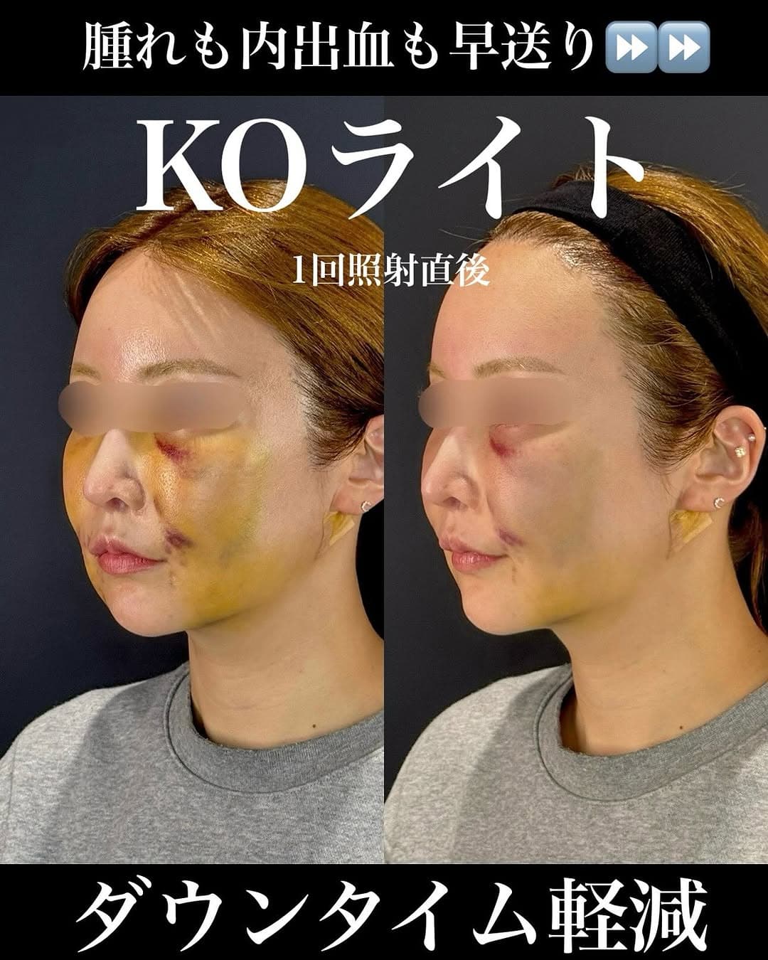 KOライトでゴールデンウィーク手術後の腫れと内出血を軽減したダウンタイム対策症例