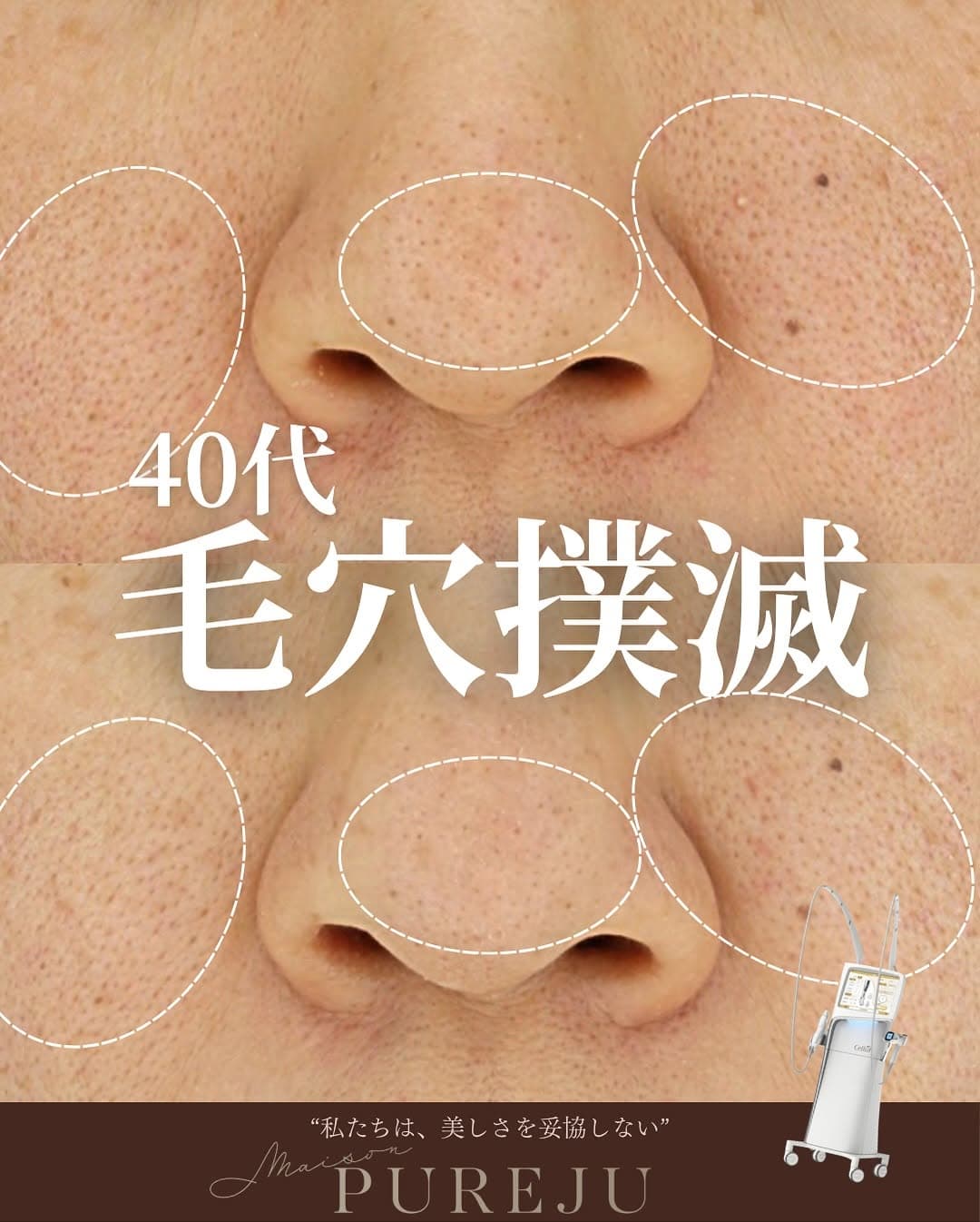 ブレッシングで頑固な毛穴をニードルRFと薬剤の相乗効果で改善した症例