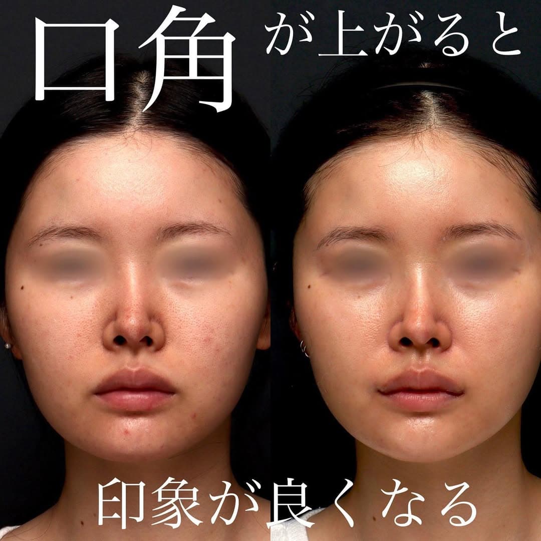 口角挙上でふとした瞬間の口角を上げ第一印象を改善した症例