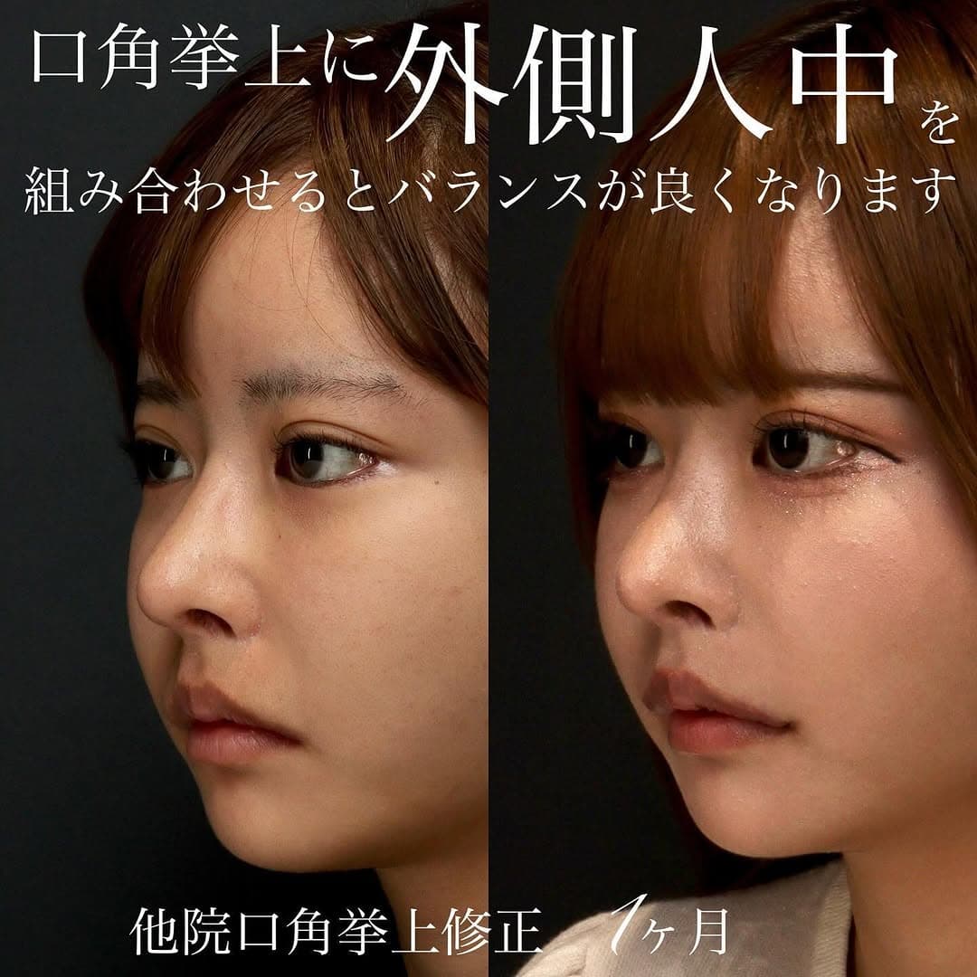 他院人中短縮後の口角挙上+外側人中で唇全体のバランスを整えた症例