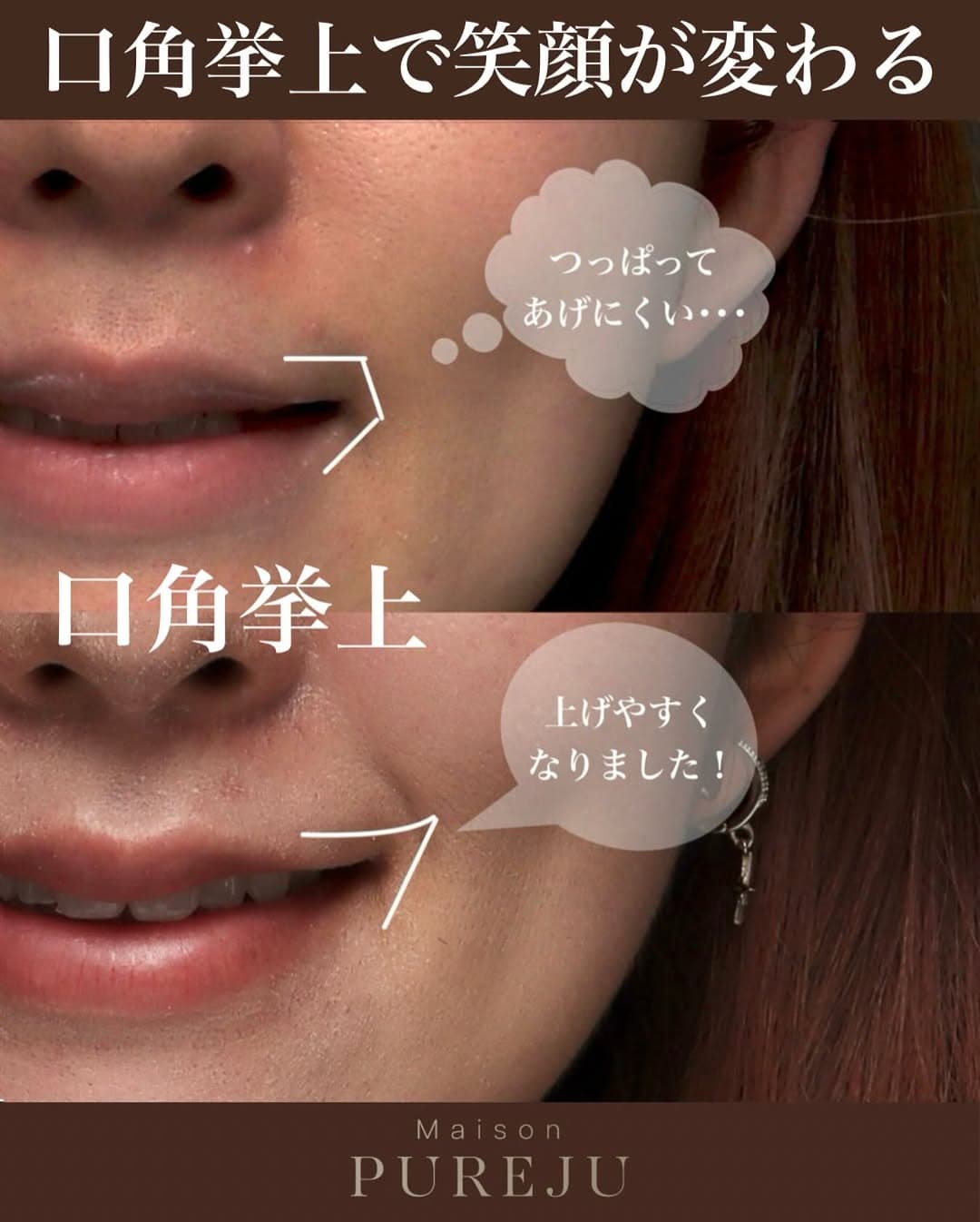 口角挙上で笑い方の悩みを解消し笑顔に自信が持てるようになった症例