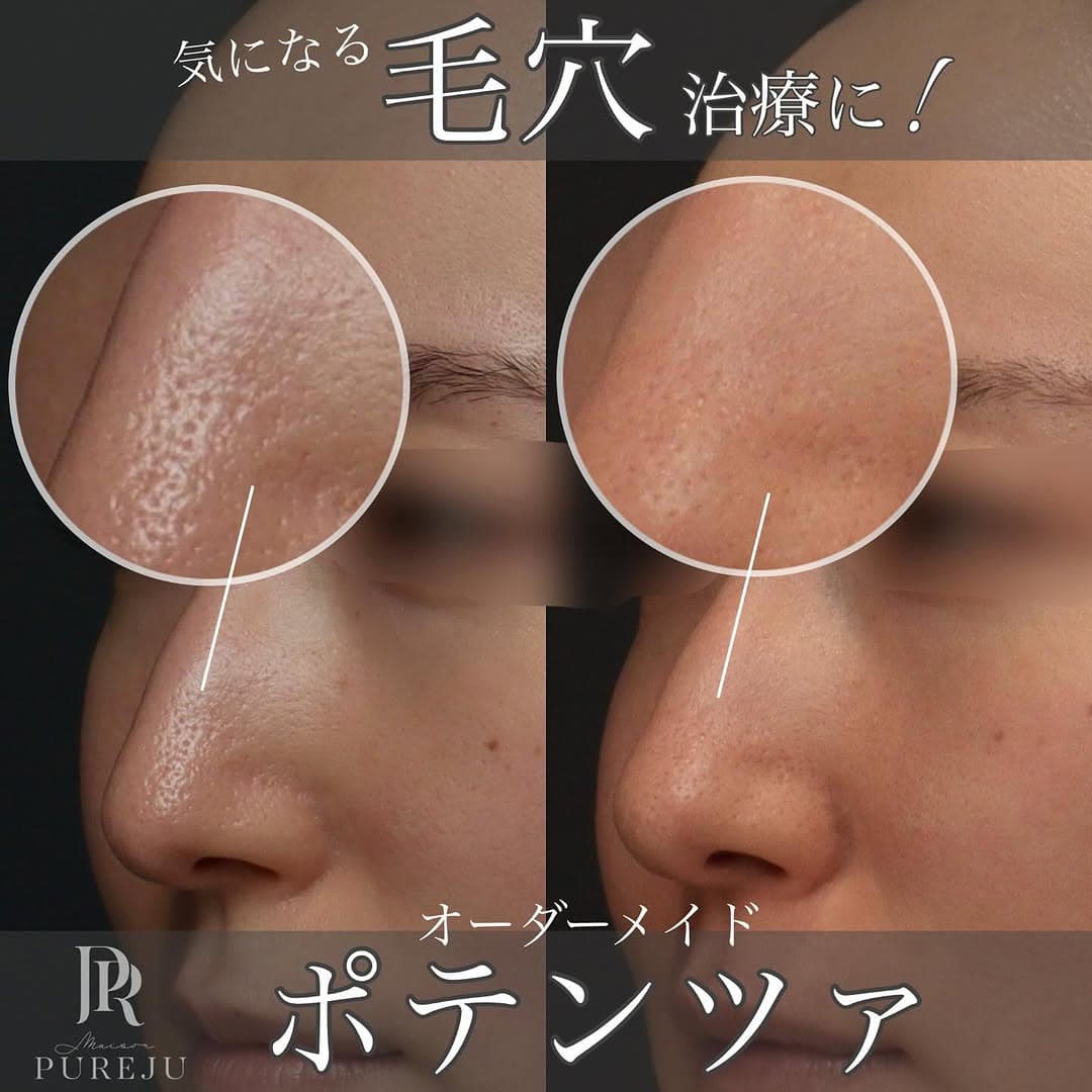 ポテンツァで鼻の毛穴を皮脂コントロールから引き締めまでオーダーメイドに改善した症例