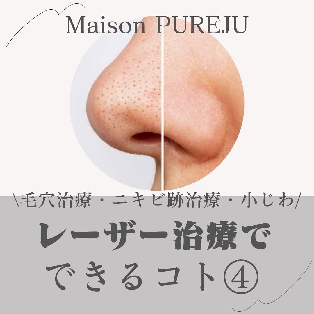 1064フラクショナルとは|衝撃波で毛穴・ニキビ跡・小じわをコラーゲン再生で改善