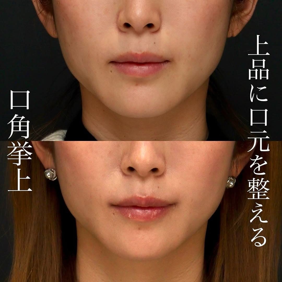 口角挙上でナチュラルに上品な変化を実現した症例