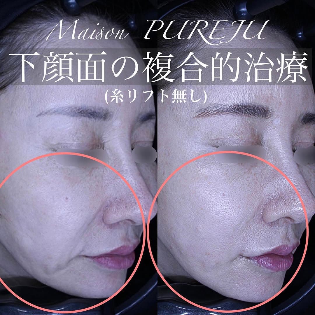 ジャルプロ+ショートスレッド+シルキー注射+口角挙上の複合治療で口横のたるみを整えた症例