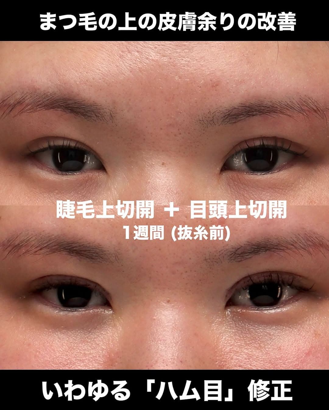 睫毛上切開+目頭上切開でハム目を修正し綺麗な目元に整えた症例(術後1週間)