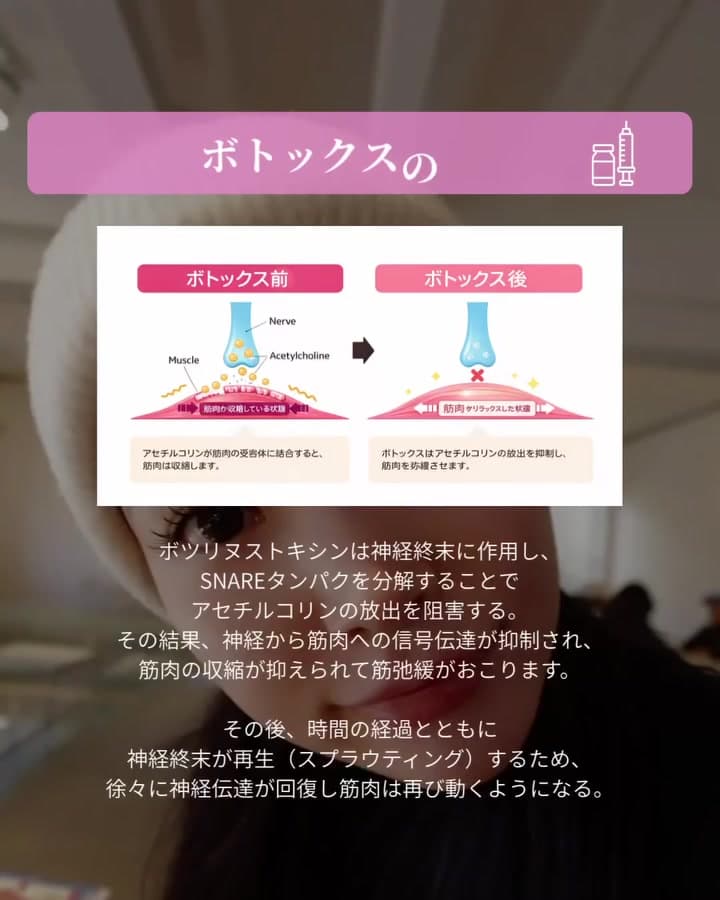 ボツリヌストキシン製剤の選び方。たかがボトックス、されどボトックス