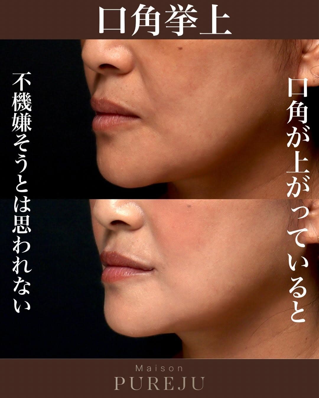 口角挙上で不機嫌そうに思われる悩みを解決した症例