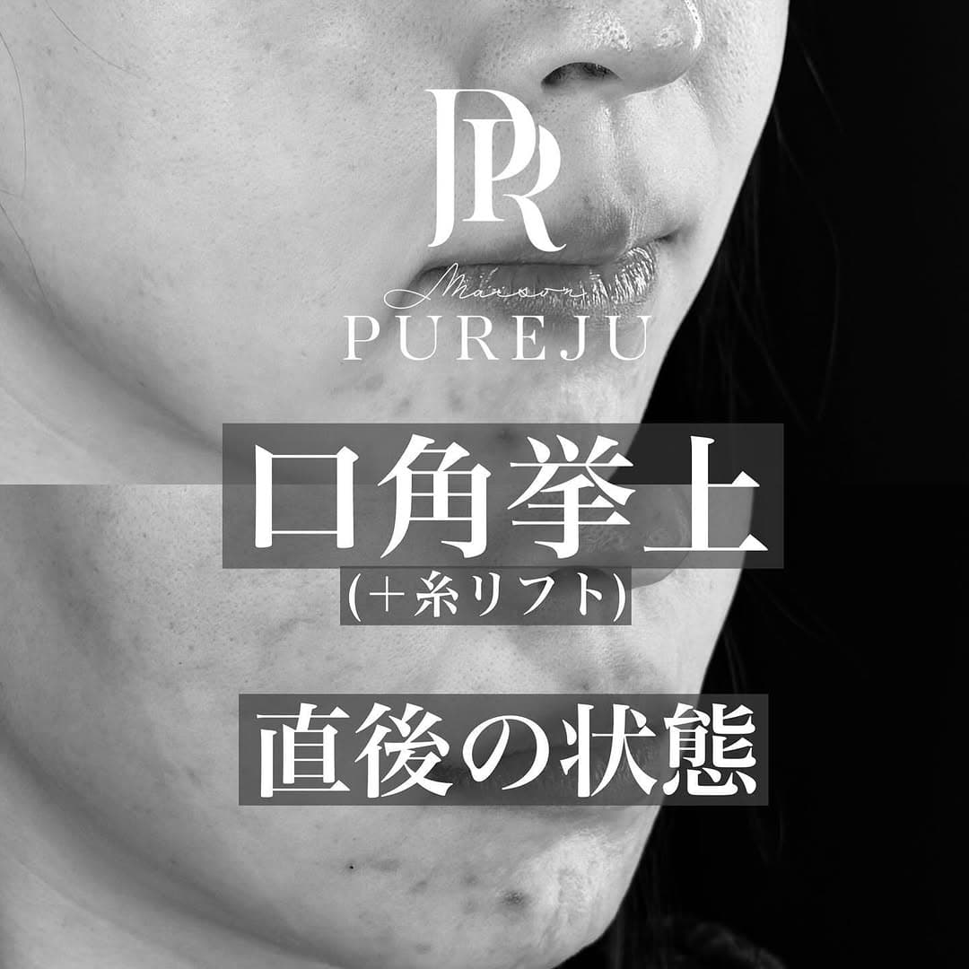 口角挙上+糸リフトの直後ダウンタイム経過を示した症例