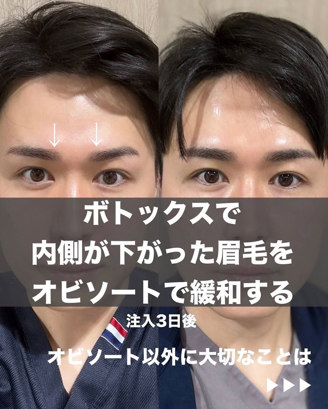 おでこのボトックス後に生じたスポックブローをオビソートで調整した症例