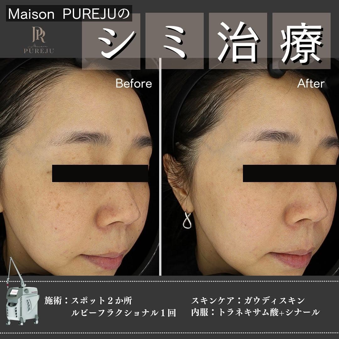 シミ治療の3ステップ|プレ・照射・アフターケアまで一貫して行うMaison PUREJUのアプローチ