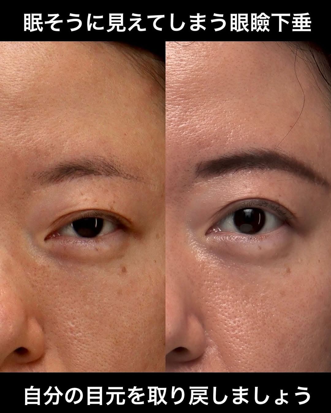眼瞼下垂手術で本来の自分の目元を取り戻した症例