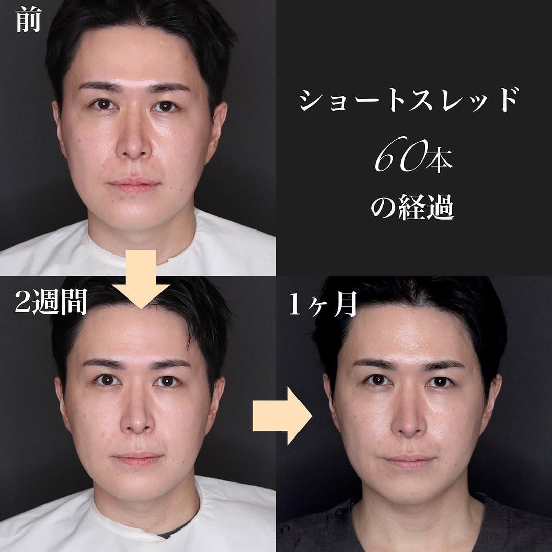 ショートスレッドで口横のたるみ・ゆるみを引き締めた症例(施術後1ヶ月)