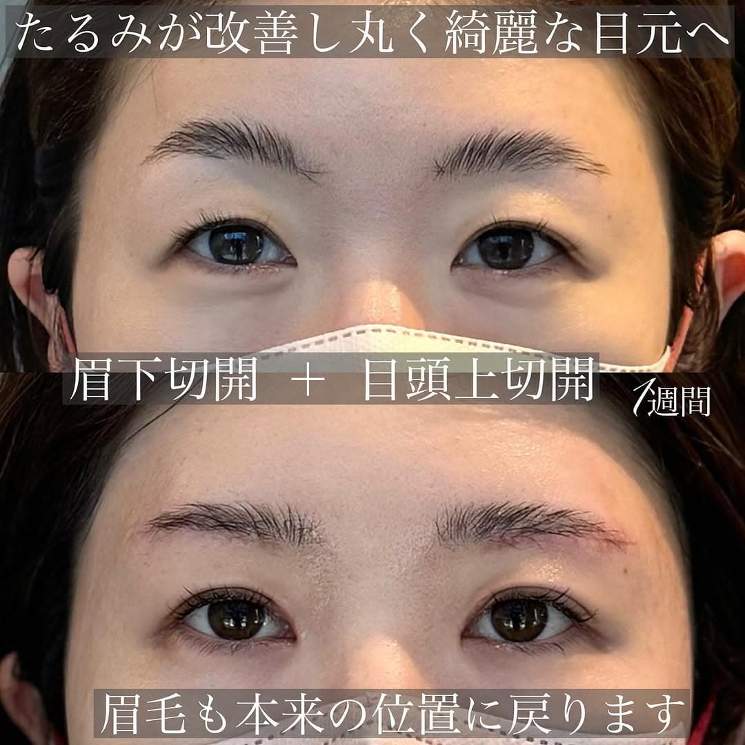 眉下切開+目頭上切開でまぶたを全体的にすっきりさせた症例(術後1週間)