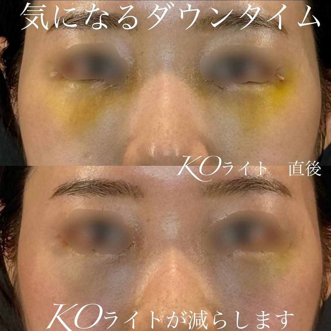 KOライトで術後の腫れと内出血を大幅に軽減したダウンタイム対策症例