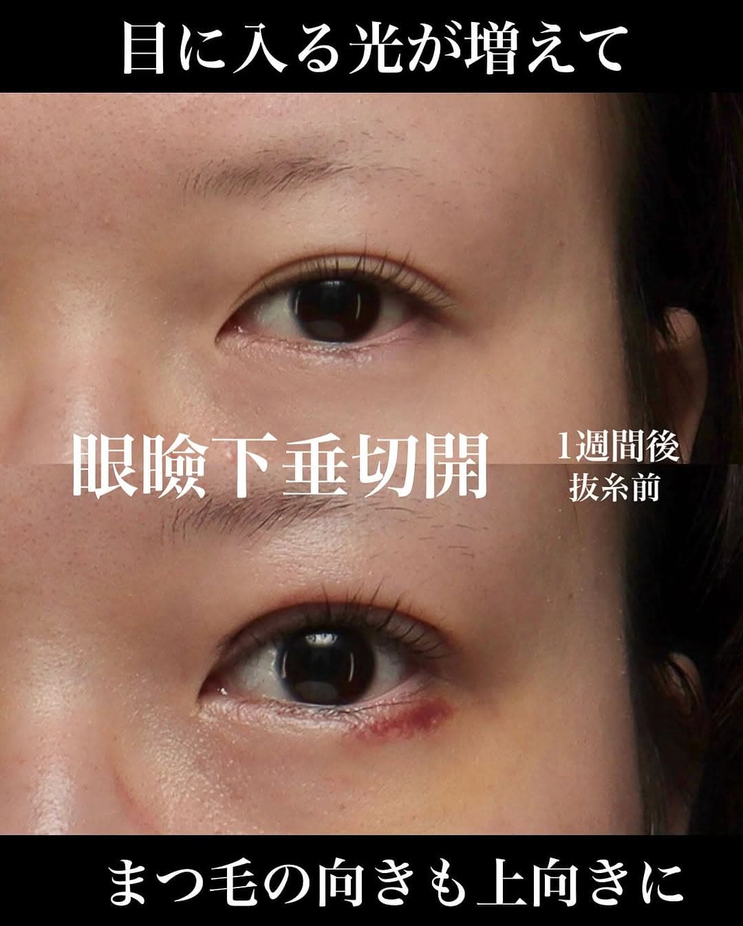 眼瞼下垂手術で黒目全体が見えるようになりまつ毛も上向きになった症例(術後1週間)