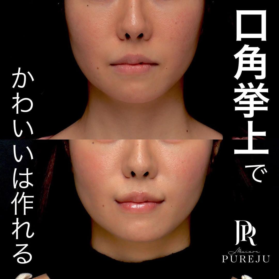 口角挙上で笑いやすさと口角の上がりを同時に改善した症例