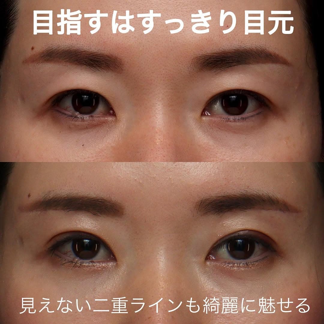 眉下切開+二重埋没でたるみで隠れていた二重ラインをすっきり出した症例
