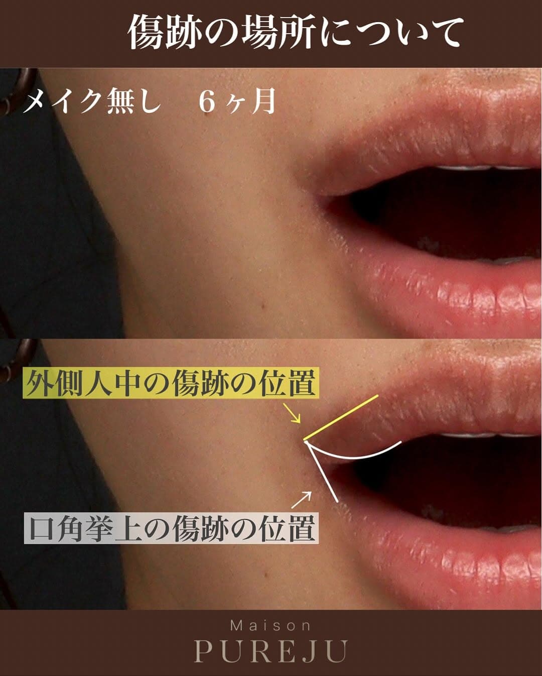 外側人中の傷跡が目立ちにくい位置と形成外科的なこだわりを示した症例
