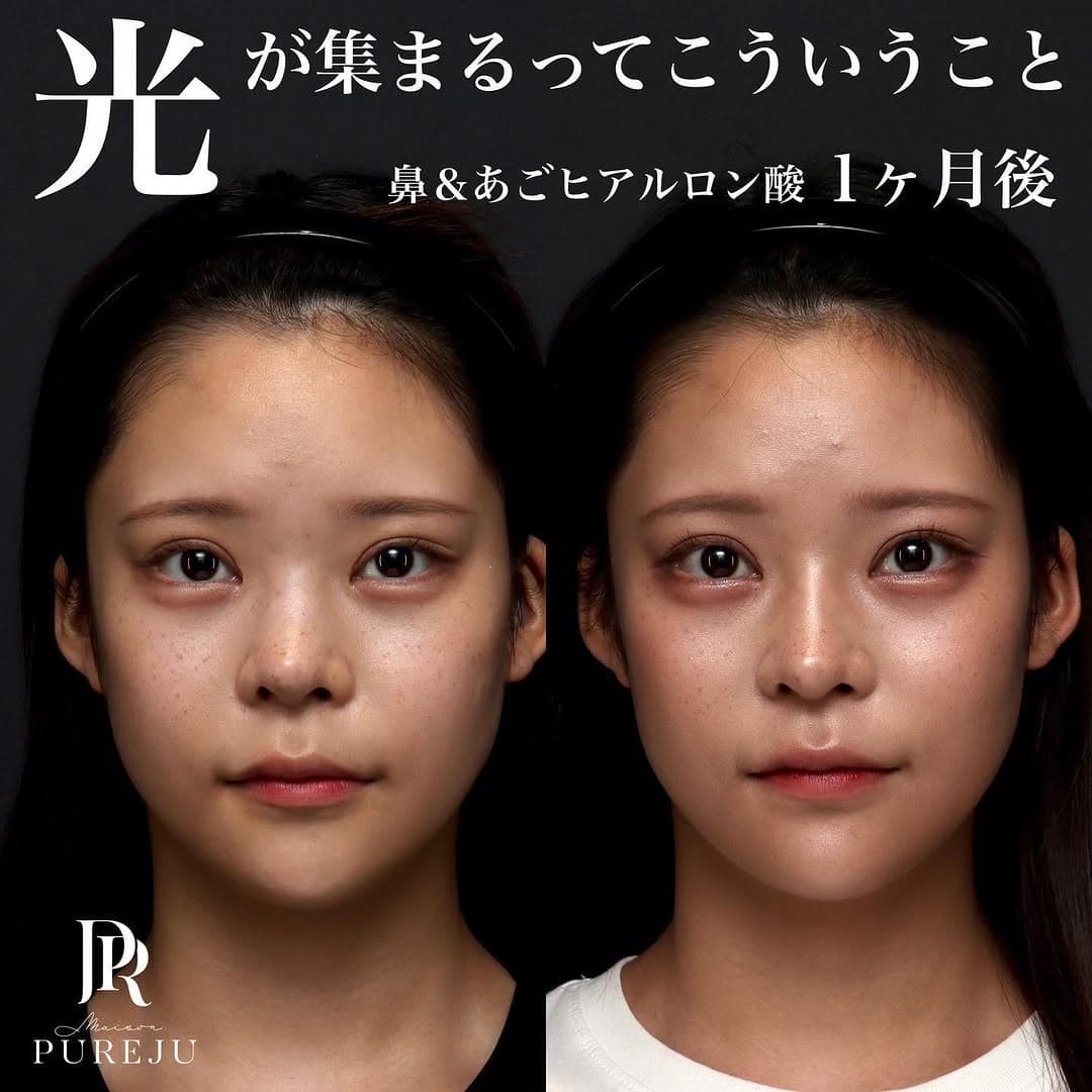 鼻&あごヒアルロン酸で光の集まり方が変わり華やかな印象になった症例(1ヶ月後)