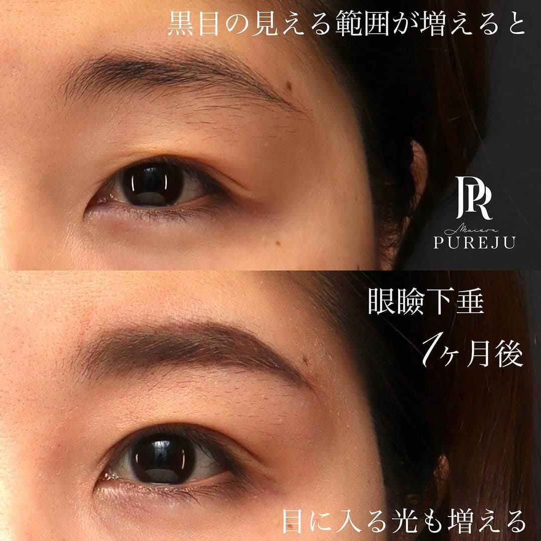 眼瞼下垂手術で黒目の見える範囲が広がり目に入る光が増えた症例(術後1ヶ月)