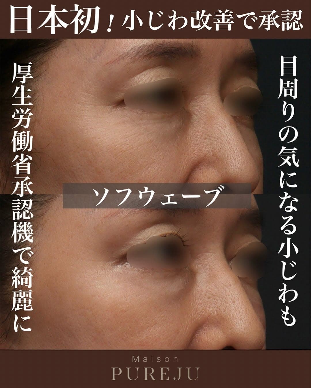 厚生労働省承認機ソフウェーブで小じわとたるみを改善した症例