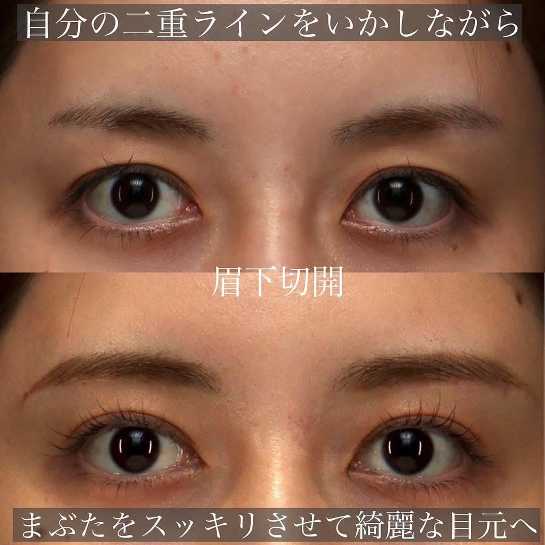 20代の眉下切開でまぶたの被さりを改善し本来の二重ラインを取り戻した症例