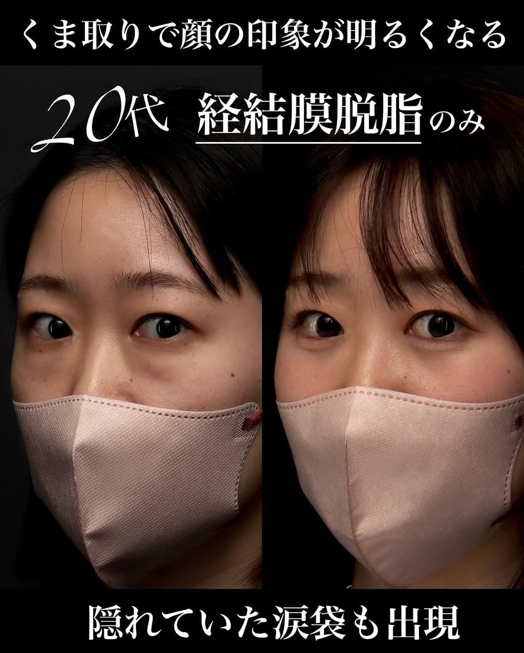 脱脂(経結膜脱脂)で目の下の膨らみを改善し明るく元気な印象になった症例