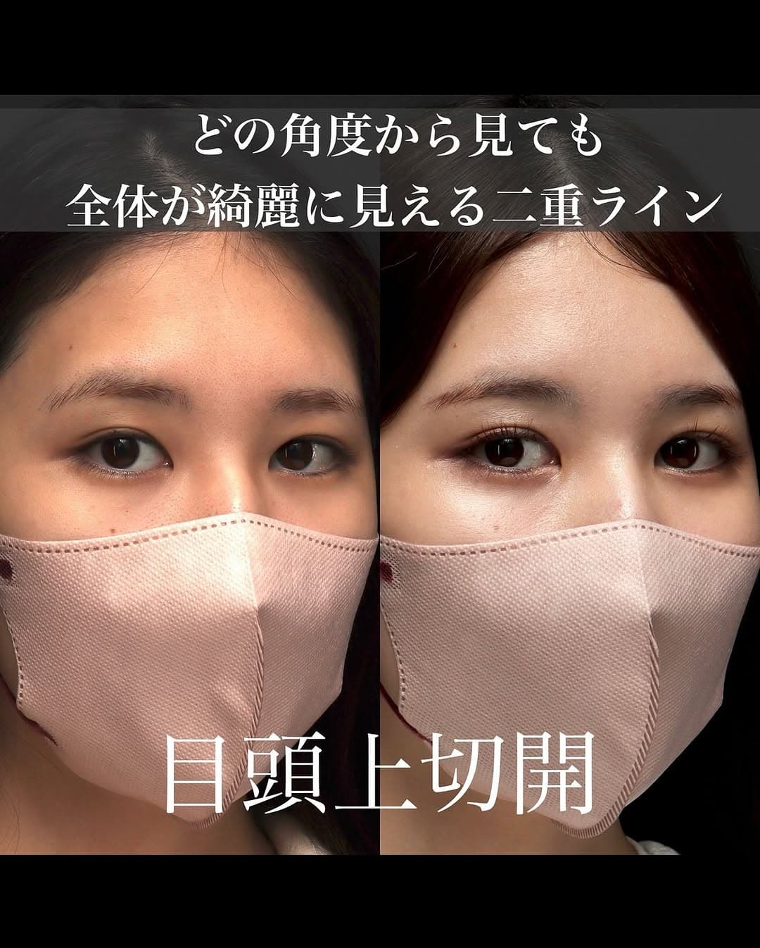目頭上切開で目頭側のたるみを改善しどこから見てもすっきりした丸い目元に整えた症例