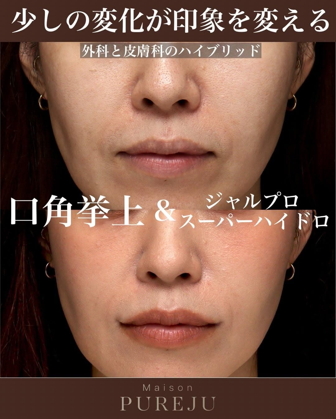口角挙上+ジャルプロスーパーハイドロで口元の若返りを実現した症例